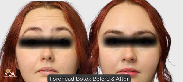Forehead Botox B&A | VIDA Aesthetic Medicine Salem, OR and Tigard, OR Forehead Botox B&A | VIDA Aesthetic Medicine Salem, OR and Tigard, OR