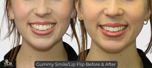 Gummy Smile _ Lip Flip Botox B&A | VIDA Aesthetic Medicine Salem, OR and Tigard, OR Gummy Smile _ Lip Flip Botox B&A | VIDA Aesthetic Medicine Salem, OR and Tigard, OR