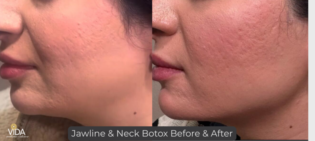Jawline and Neck Botox B&A | VIDA Aesthetic Medicine Salem, OR and Tigard, OR Jawline and Neck Botox B&A | VIDA Aesthetic Medicine Salem, OR and Tigard, OR