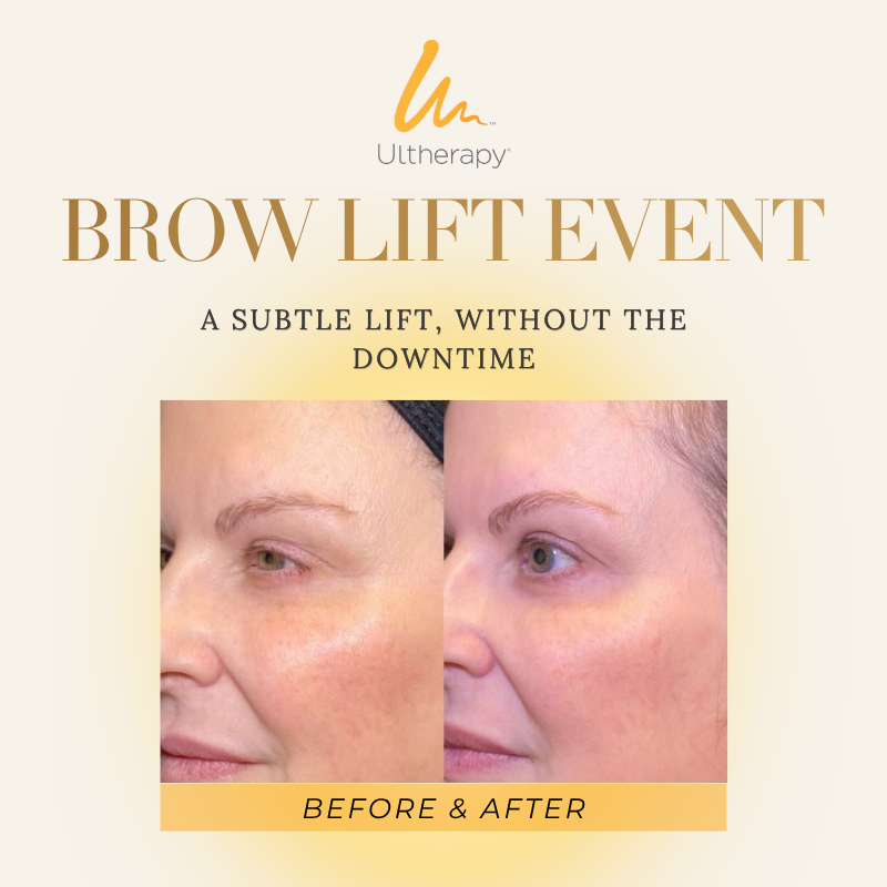 May 2026 Tigard Ulthera Event Ultherapy Before & After Brow Lift